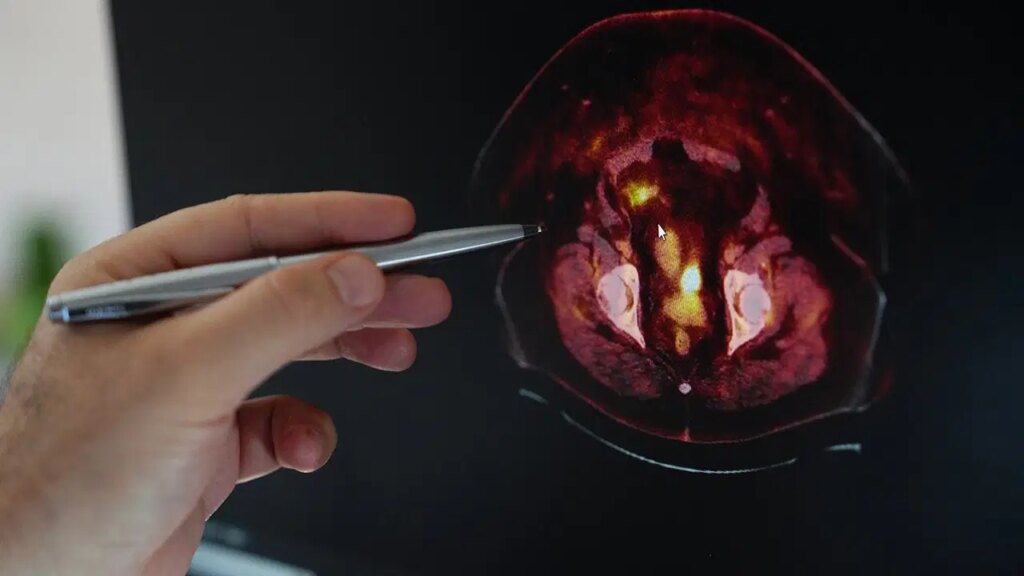 ‘Obezite, endometrium kanseri riskini artırıyor’