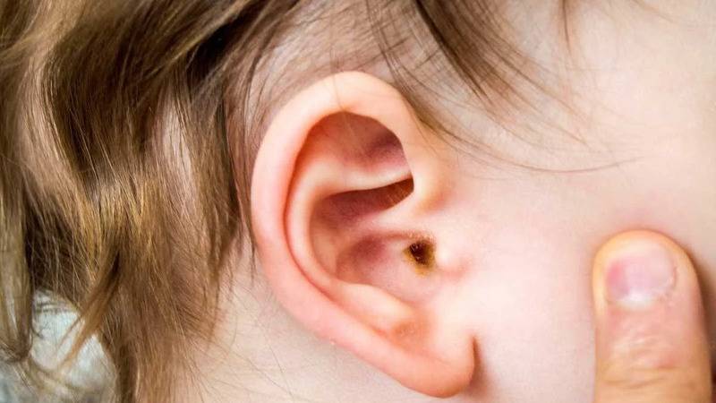 uzmani uyardi orta kulak iltihabi cocuklarda gecici isitme kaybina neden olabilir jTKpqkhJ